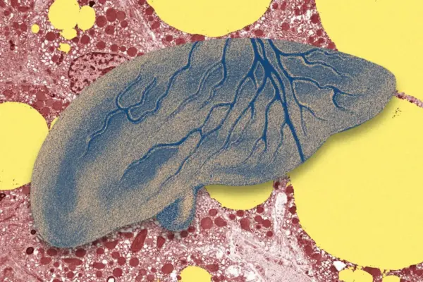 The Silent Epidemic: How Artificial Intelligence is Revolutionizing the Early Detection of Fatty Liver Disease