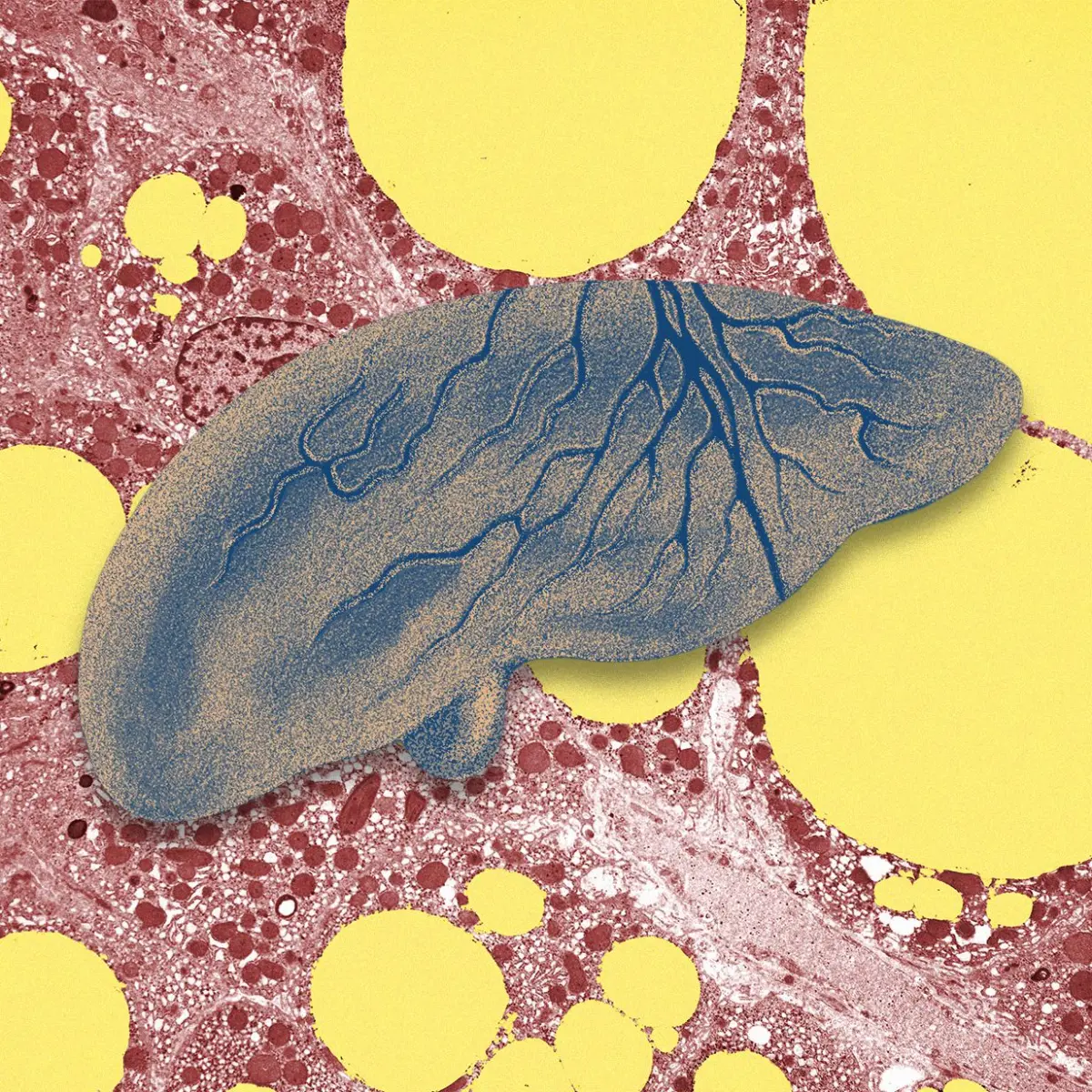 The Silent Epidemic: How Artificial Intelligence is Revolutionizing the Early Detection of Fatty Liver Disease