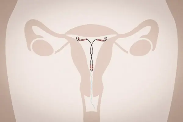 The Long-Awaited Evolution of Nonhormonal Contraception: Inside the Arrival of the Miudella Copper IUD