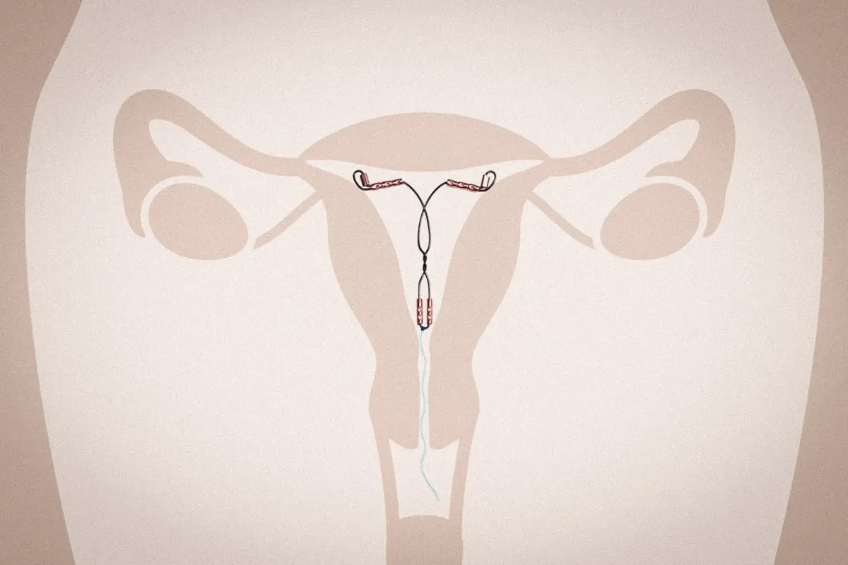 The Long-Awaited Evolution of Nonhormonal Contraception: Inside the Arrival of the Miudella Copper IUD
